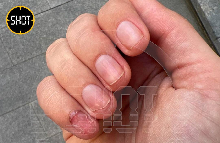 Ногти москвички, которые расщепил шеллак. Обложка © Telegram / SHOT