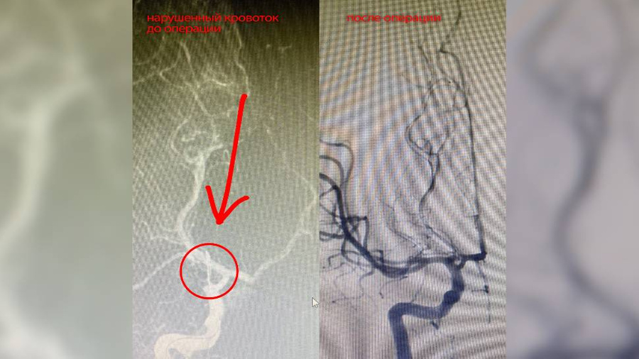 Нарушенный кровоток до операции и после. Фото предоставлено Лайфу