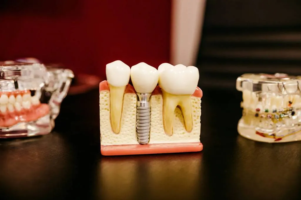 Стоматолог назвал имплантацию самым лучшим методом восстановления зуба