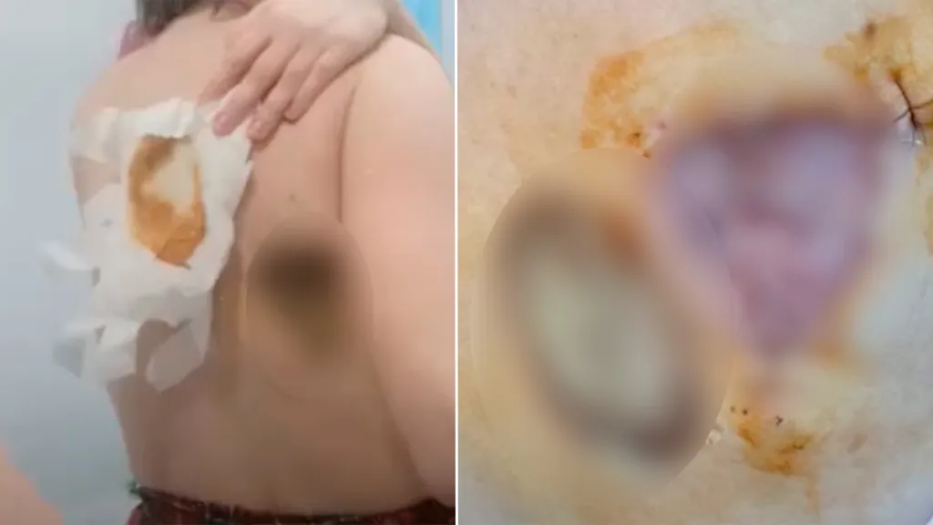 Дикая боль и огромная дыра в спине: Жительнице Тюмени потребовалась пересадка кожи после операции