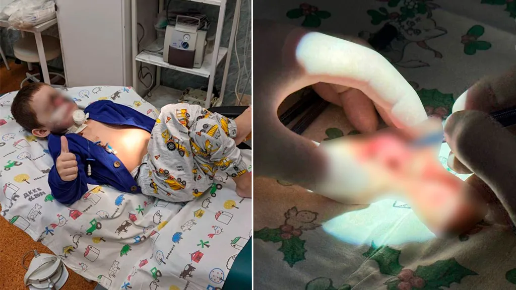 В Краснодаре хирурги восстановили лицо мальчика, которое целиком откусила собака