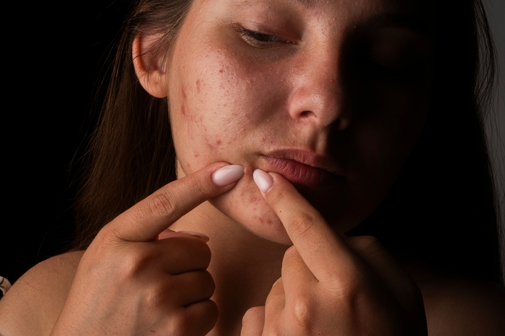 Дерматолог объяснила, почему вакцина не может избавить от акне навсегда