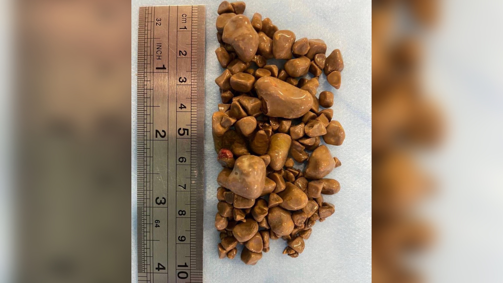 Из почек россиянки достали свыше сотни камней. На здоровье она не жаловалась