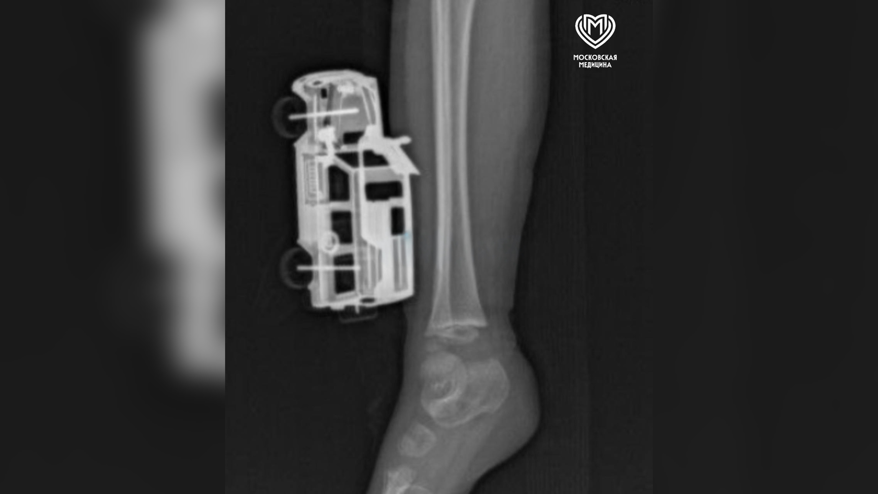 Московские врачи спали ребёнка, которому в ногу впилась игрушечная машинка