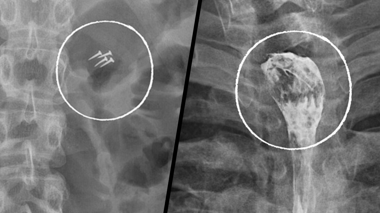 Склиф составил список самых странных находок внутри пациентов за 2025 год