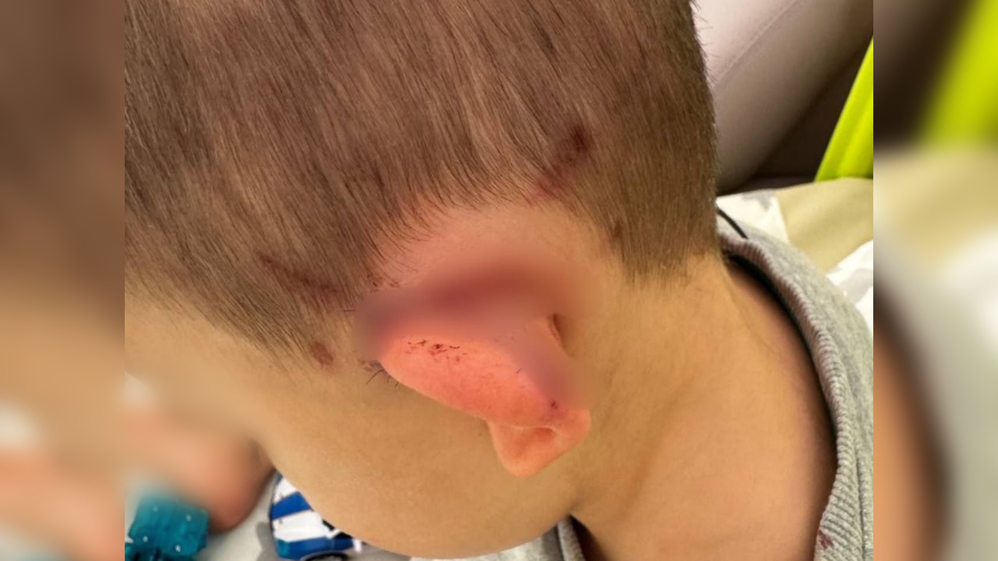 В Подмосковье 4-летнему мальчику пришлось наложить 25 швов после нападения стаи псов