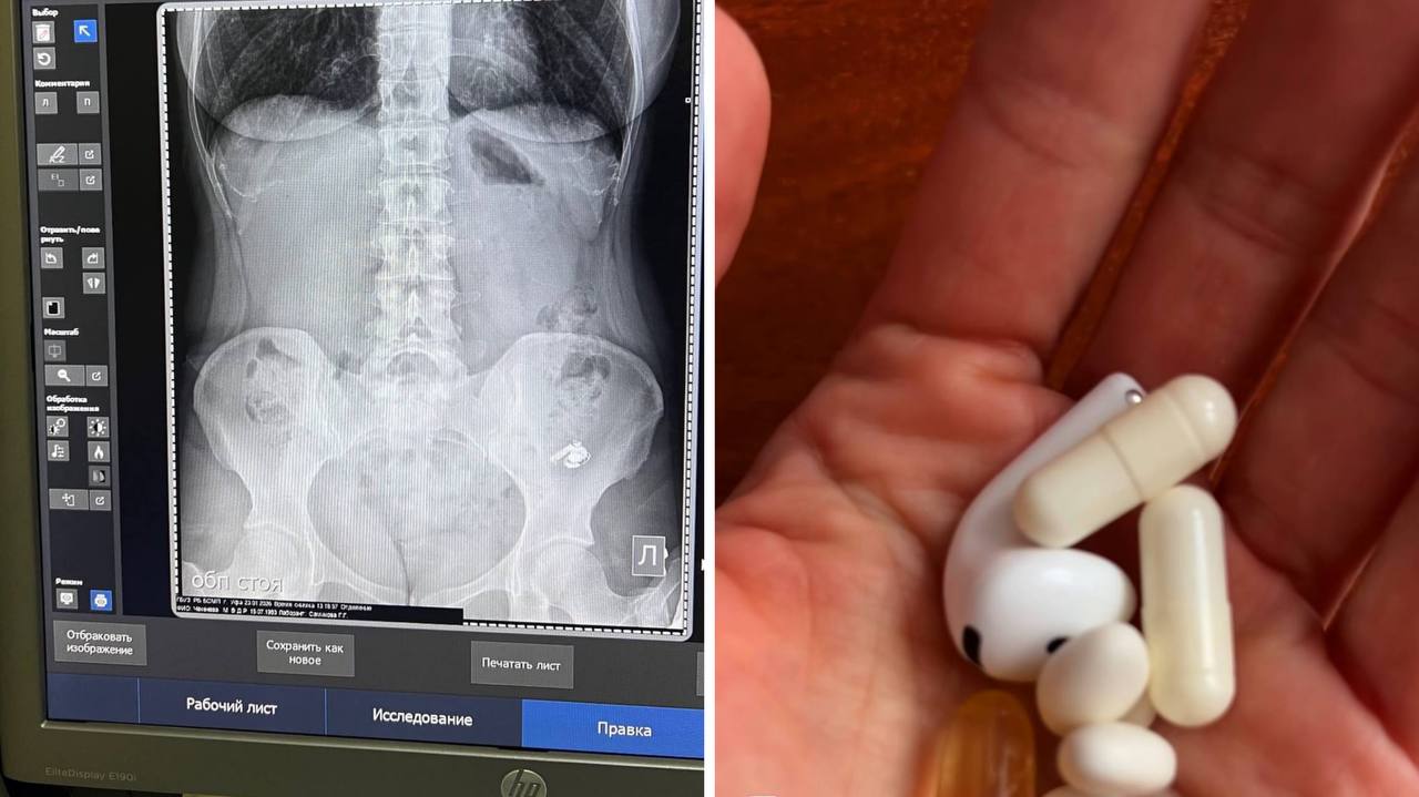 Психолог из Уфы проглотила наушник AirPods, приняв его за таблетку