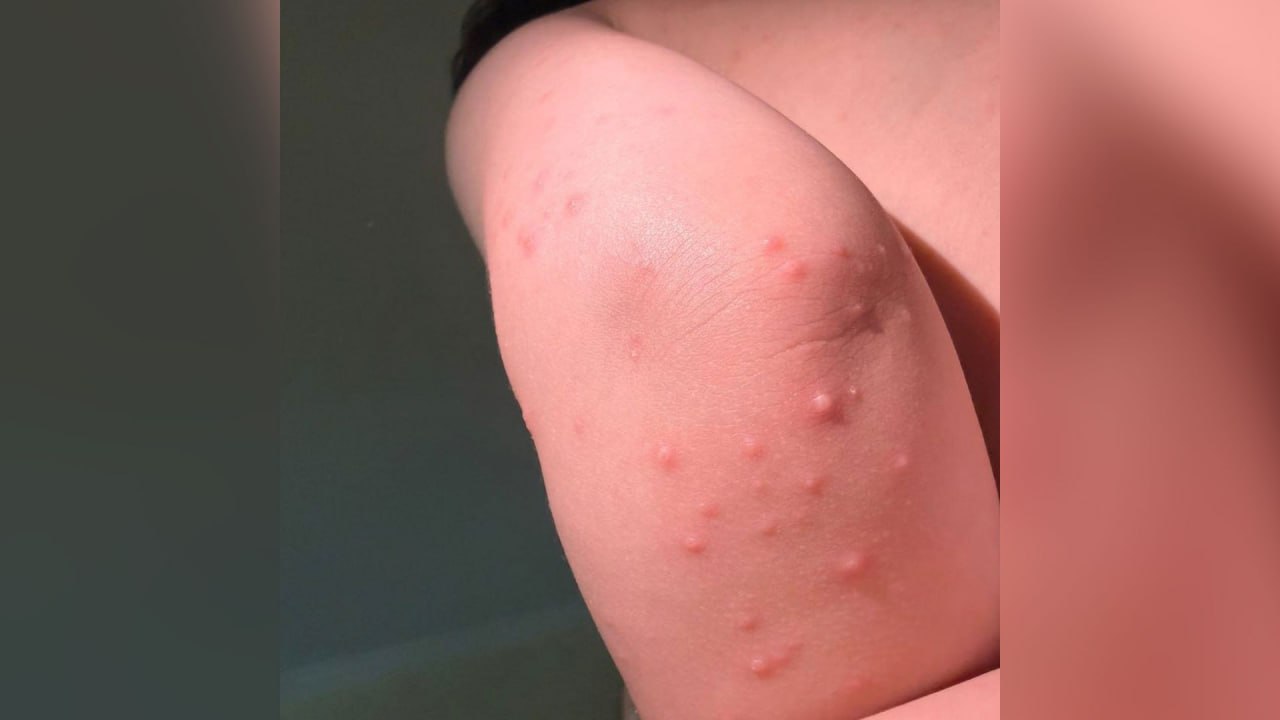 Полуторагодовалый ребёнок из России покрылся жуткой сыпью на отдыхе в Таиланде