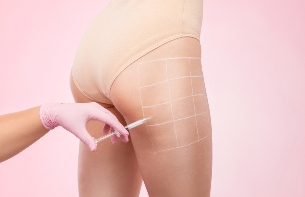 Россиянке грозит ампутация ног после липосакции ягодиц