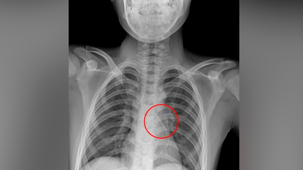Московские хирурги спасли 11-летнего мальчика, вдохнувшего булавку