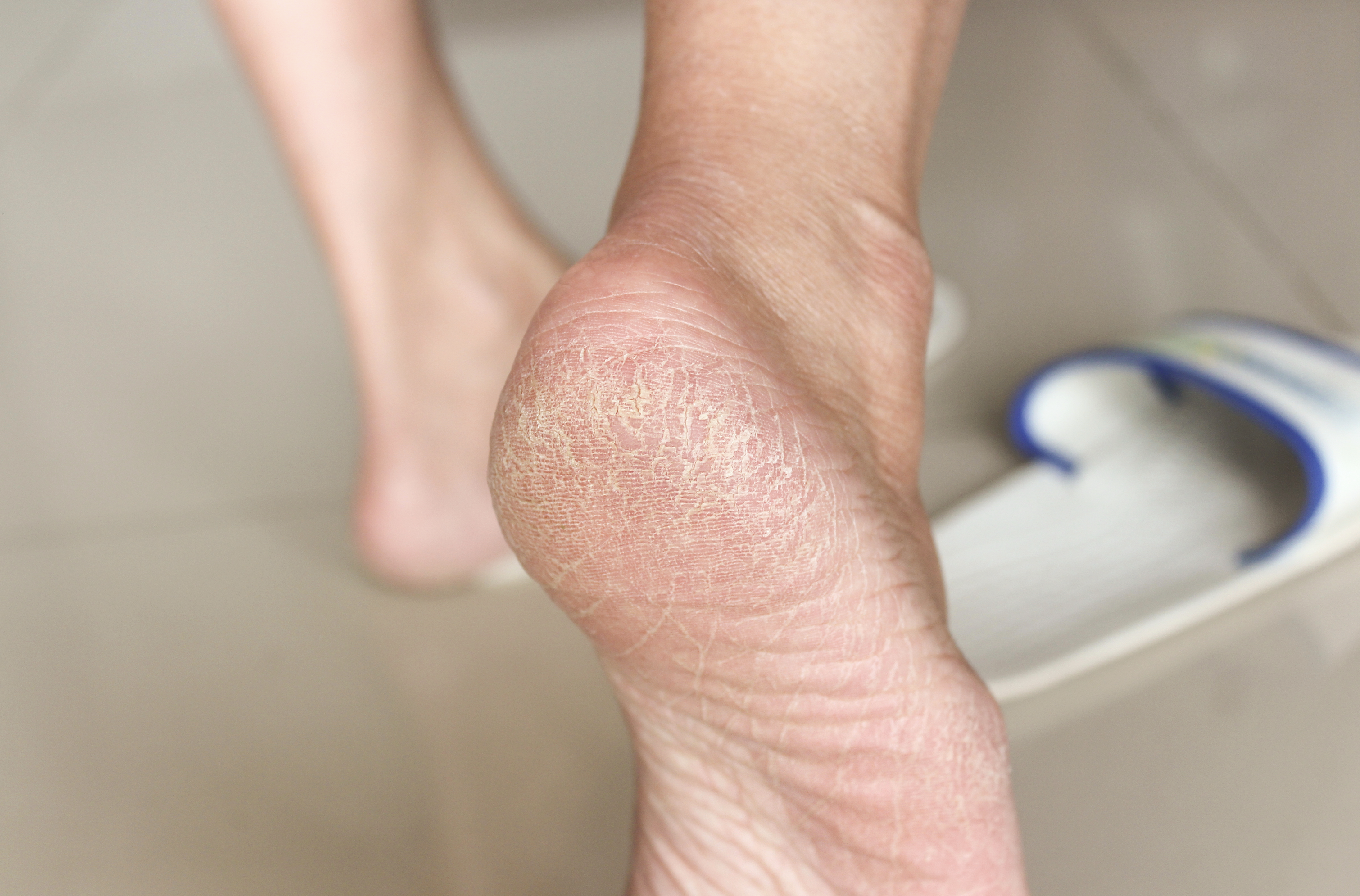 Кусь за пятку тёщи стоил зубастому россиянину 5 тысяч рублей