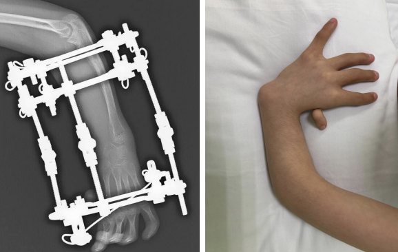Подмосковные врачи исправили ребёнку врождённую косорукость