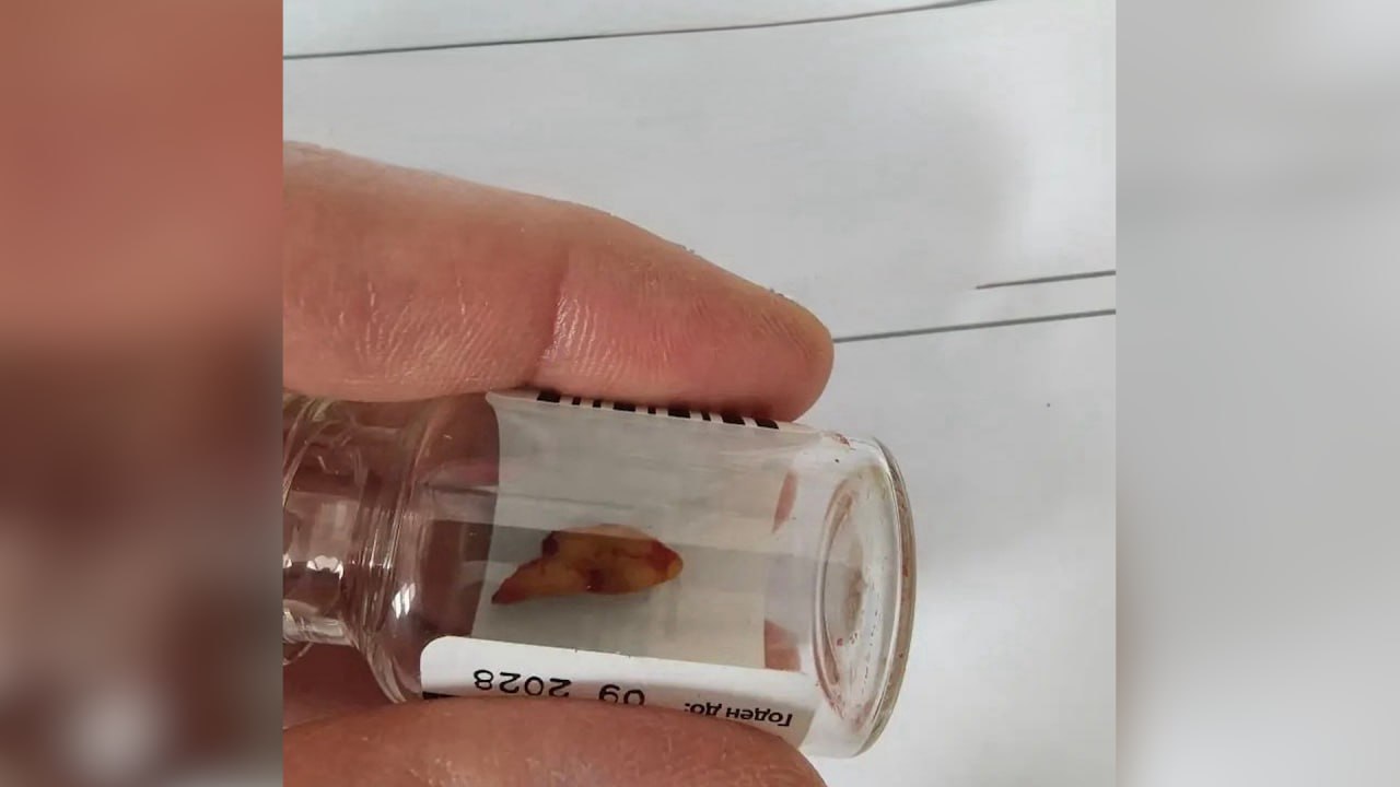 Мужчина чуть не задохнулся из-за &laquo;переехавшего&raquo; в нос зуба