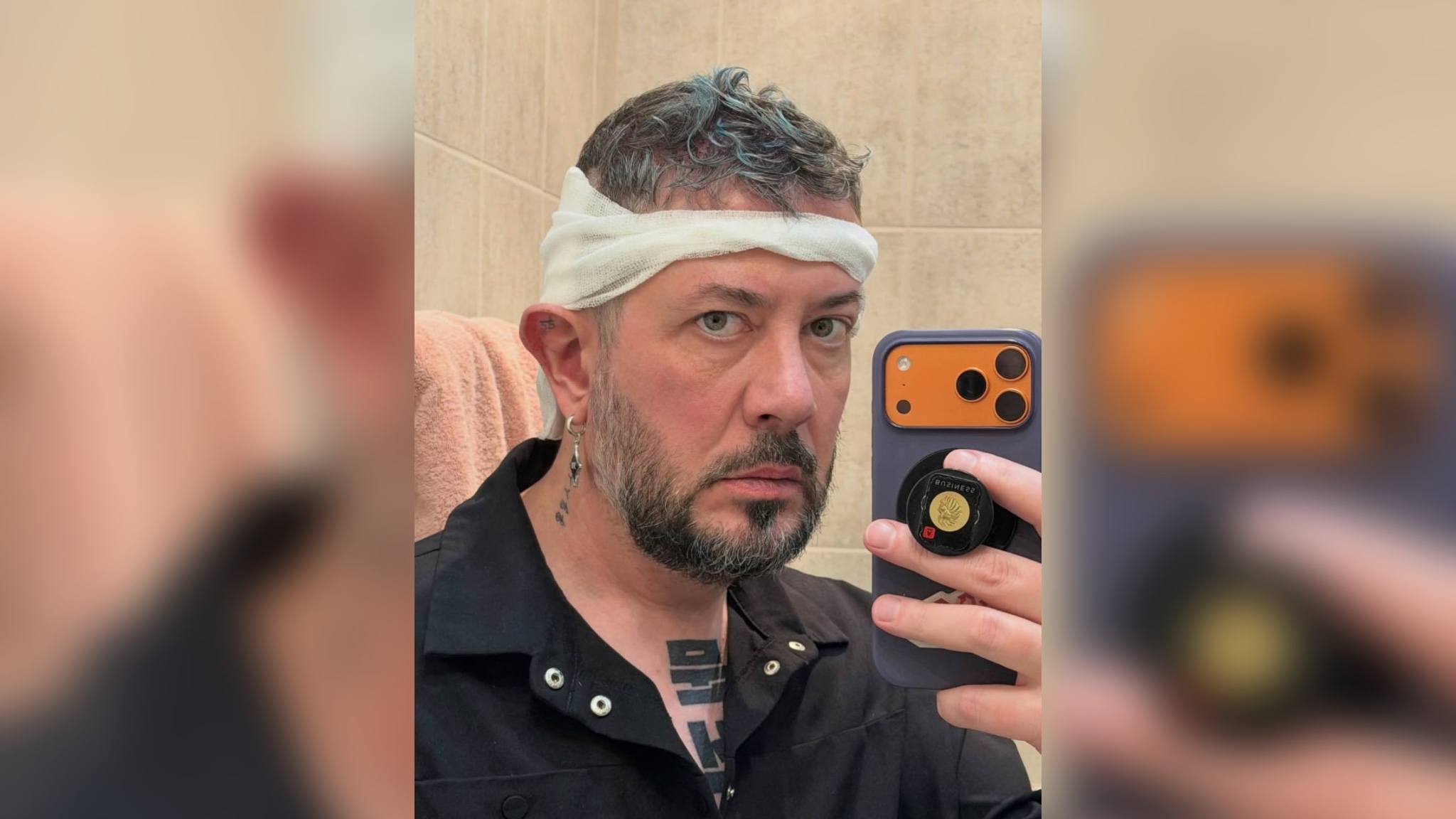 &laquo;Пусть будет густо там, где видно&raquo;: Артемий Лебедев иронично отчитался о пересадке волос