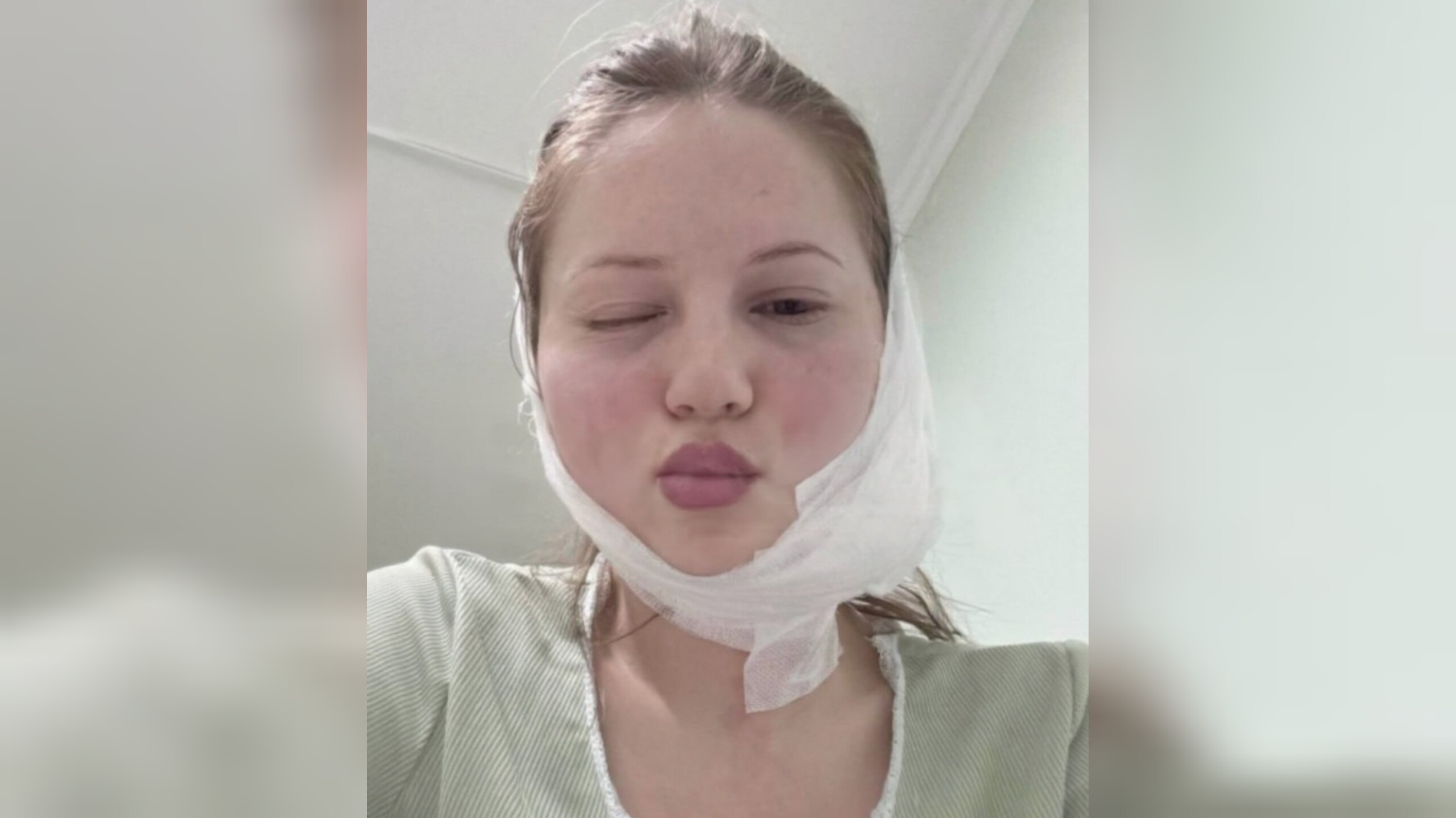 Удаление зуба мудрости обернулось для россиянки опухолью и перекошенным лицом