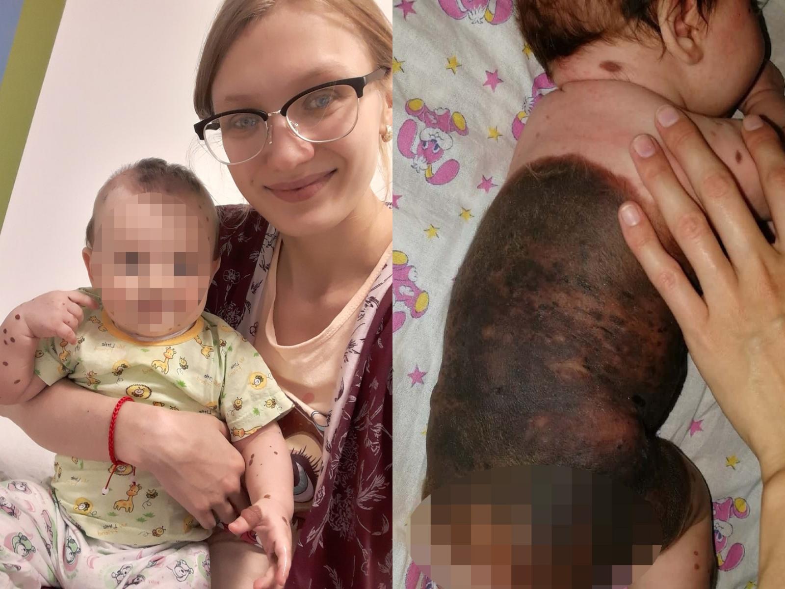 Маму из Кургана, чья дочка родилась с большим родимым пятном, захейтили в  соцсетях после сториз блогерши