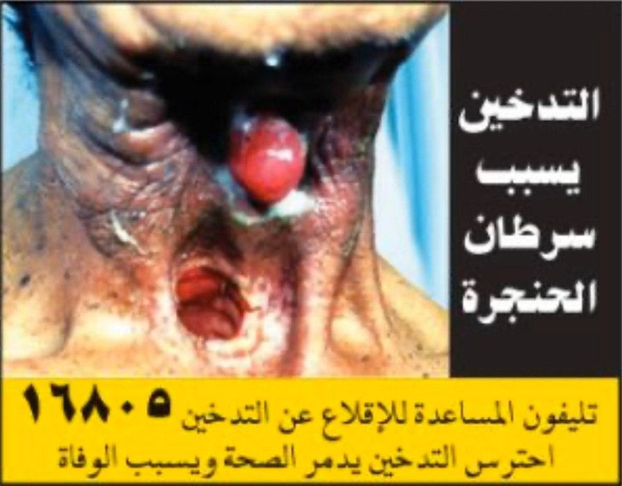 Египетские сигареты показывают, как выглядит рак гортани