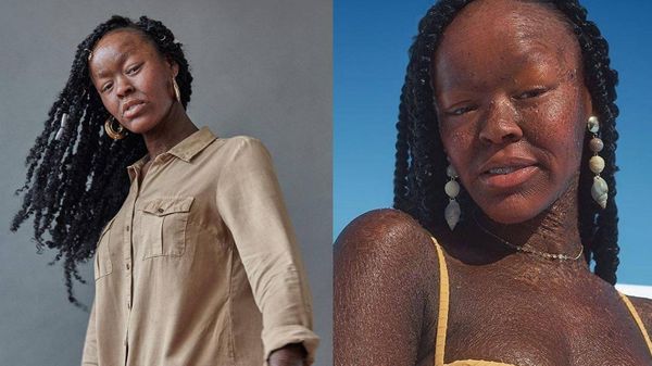 10 вдохновляющих фото девушки, которая стала моделью, несмотря на "змеиную кожу"