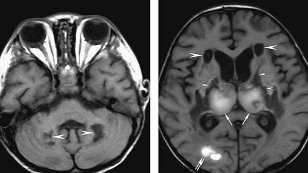 Врачи всё чаще обнаруживают у пациентов серьёзные повреждения мозга, вызванные CoViD-19