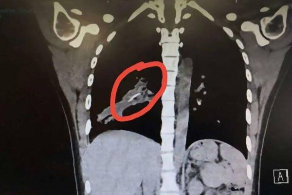 Девушка 14 лет гадала о причине сильного кашля, пока врачи не обнаружили в её лёгком куриную кость