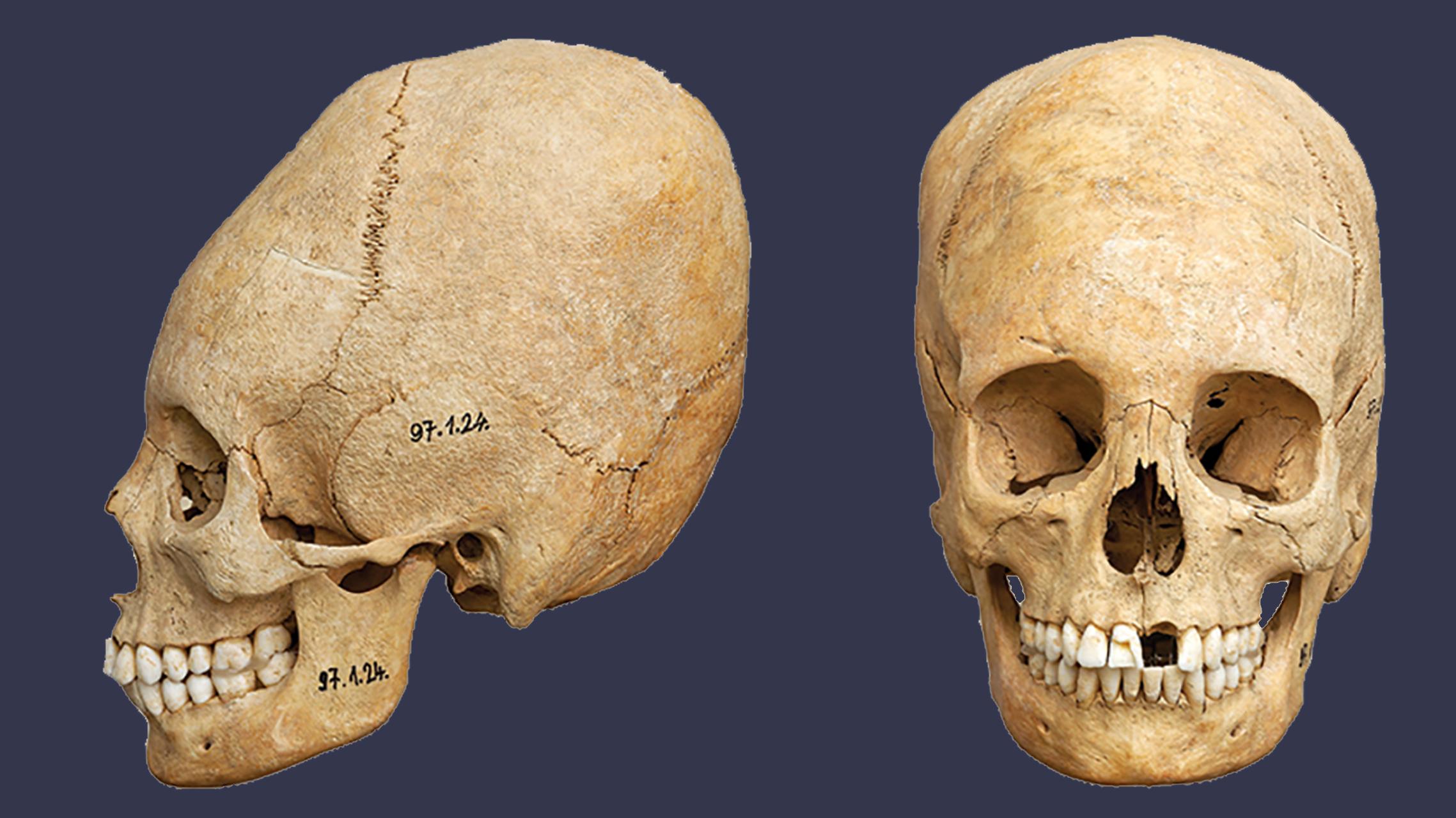 В Венгрии нашли кладбище времён Римской империи. Почему черепа такие длинные?
